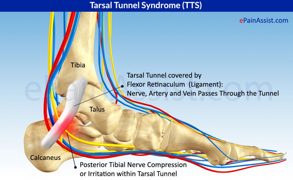 Tarsal Tunnel Syndrome
